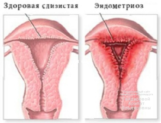 Эндометриоз
