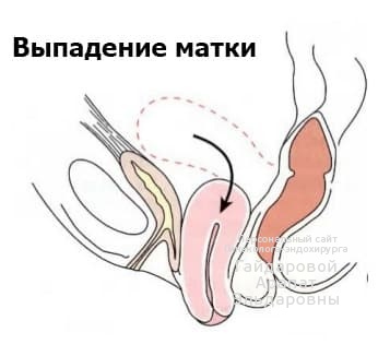 Выпадение матки: симптомы, диагностика и лечение