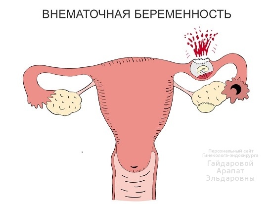 Внематочная беременность: причины и последствия