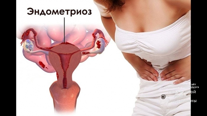 Эндометриоз и бесплодие