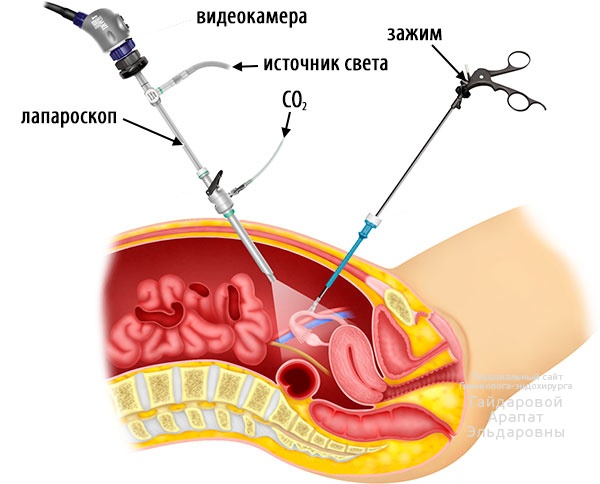 Лечение бесплодия при эндометриодных кистах яичников
